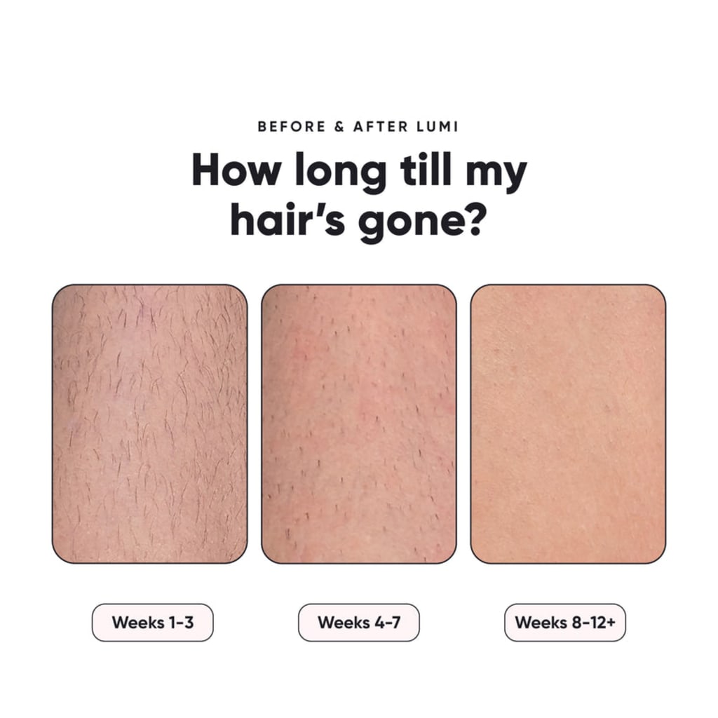 LumaBelle™ Laser Hair Removal
